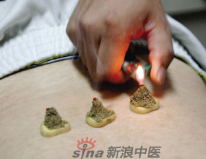 灸法的種類  你知道多少？